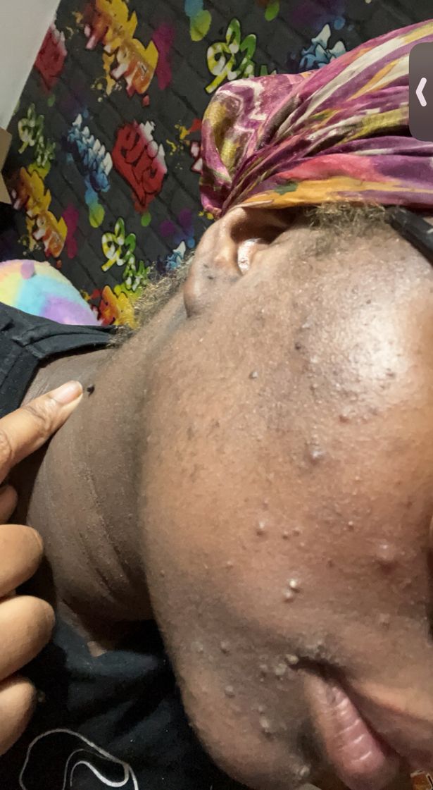 Khadejah Sutherland's skin was among the first signs something was wrong (Jam Press)